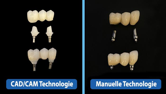 Digitale Zahnmedizin - der Implantat Stumpf aus Zirkon mit monolithischer Zirkon Krone (CAD/CAM)